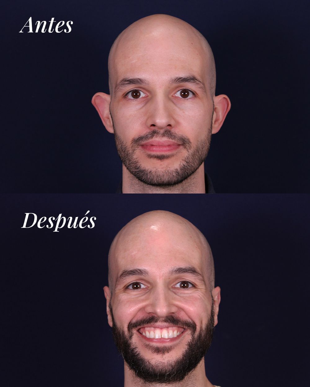 Otoplastia