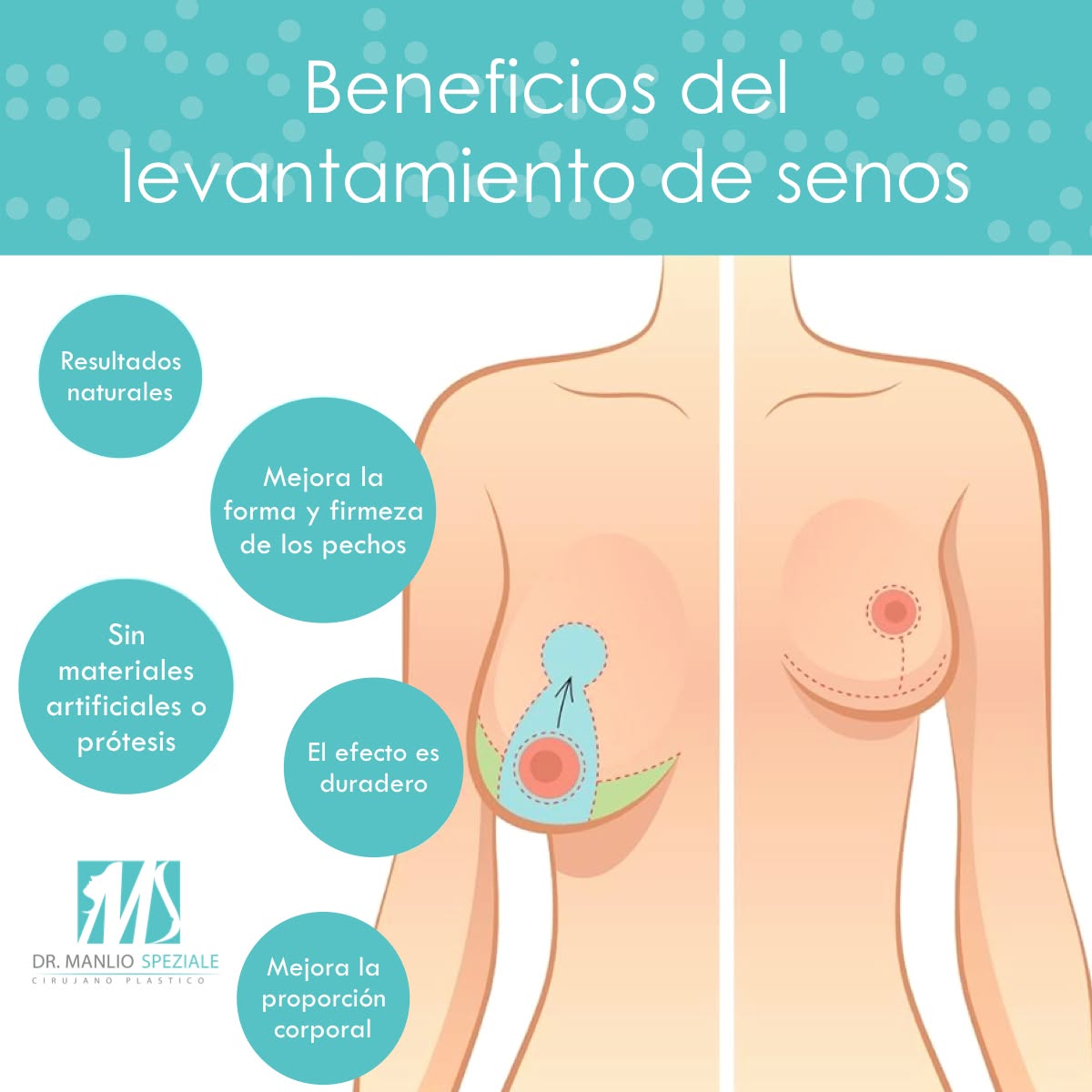 Levantamiento Mamario