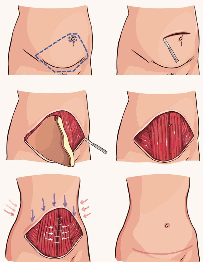 Abdominoplastia