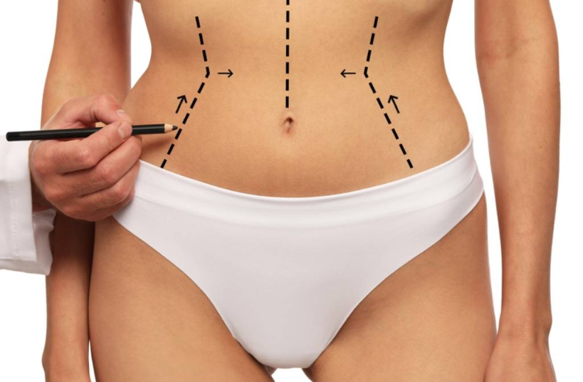 Liposucción Corporal